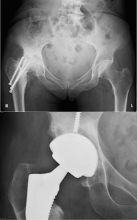 hip-replacement-operation
